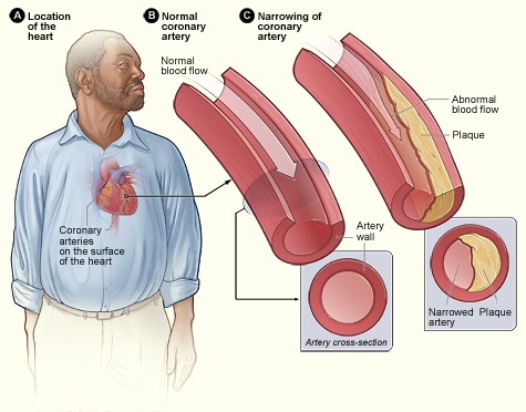 Figure 1: The effect of plaque formation on coronary artery in the heart 